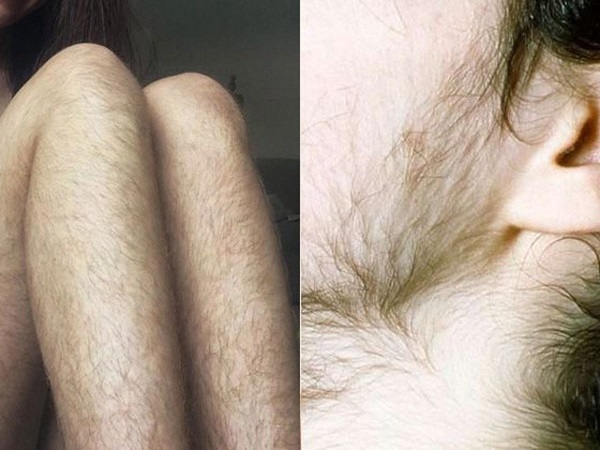 Rối loạn nội tiết tố MTC