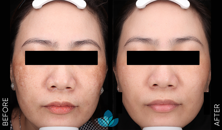 Nám – tàn nhang – bớt sắc tố